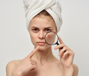 Opar nebo akné? Jak rozeznat rozdíl a účinně je léčit.